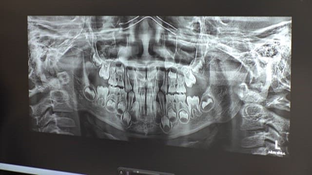 Analysis of Dental X-ray Images on Display