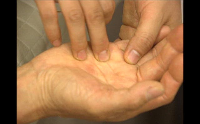 Doctor Treating a Patient with Acupuncture on His Hand