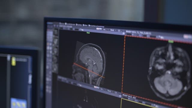 Close-up of Medical Brain Imaging on Monitor