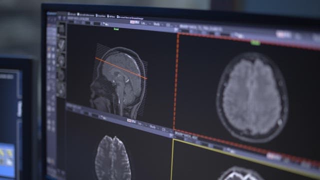 Brain Scan Imaging on Monitor