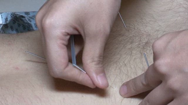 Close-Up of Acupuncture Treatment on Skin