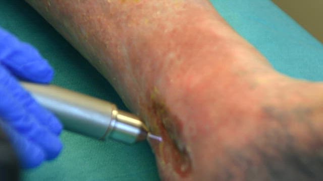 Medical procedure on a patient's leg with plasma flames