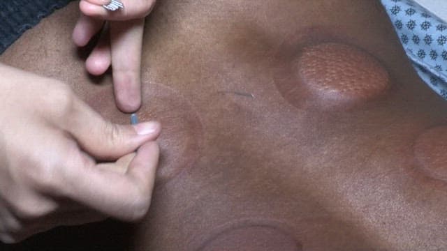 Oriental Medicine Doctor Applying Acupuncture on the Cupped Area